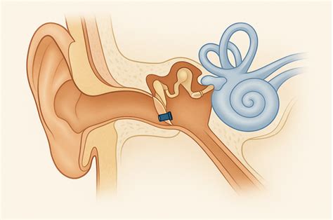 Ear Tubes Risks