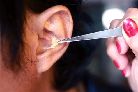 Deep Layered Ear Wax Over Eardrum Removed Mr Neel Raithatha (The Hear