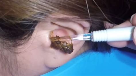 Ear Wax Huge Chunk