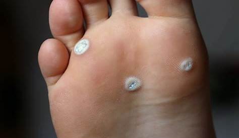 Early Stage Plantar Wart Corn On Foot Every Type Of And How To Treat It Visual Guide Allure
