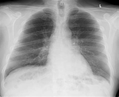 early airspace disease of the lungs