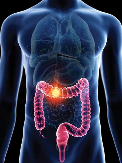 early detection of colon cancer
