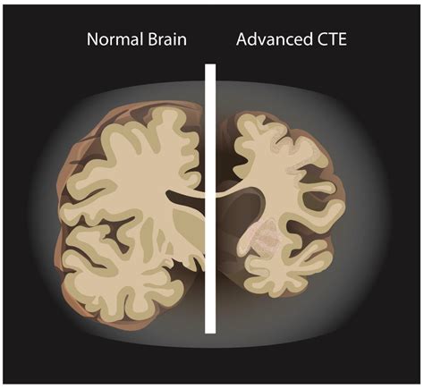 early signs of cte