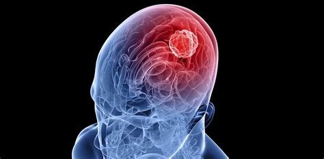 early signs of glioblastoma in adults