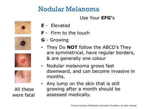 early stage nodular melanoma