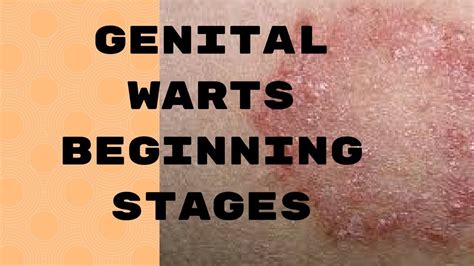 early stages of genital warts