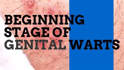 early stages of genital warts male