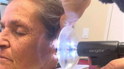 Earwax Removal Okc