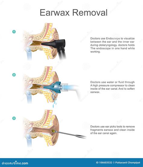 Earwax Removal Procedure