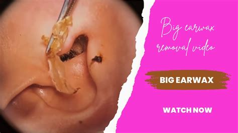 Earwax Removal Techniques