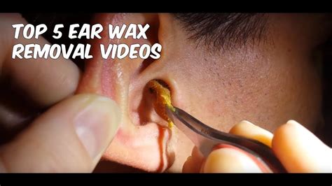 Earwax Removal Tips