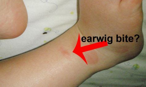 Learn 7 Details earwig bite Demystified Pest Facts Now