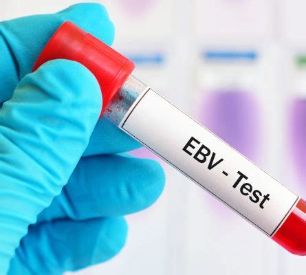EB Virus Blood Test: What You Need to Know