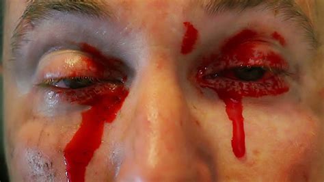 Ebola Eyes Bleeding