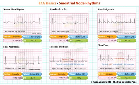 ecg interpretation normal sinus rhythm