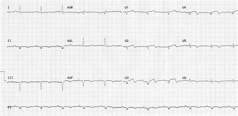 ecg results low voltage qrs