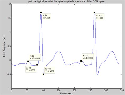 Ecg Signal Analysis In Matlab Code