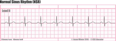 ecg within normal limits sinus rhythm