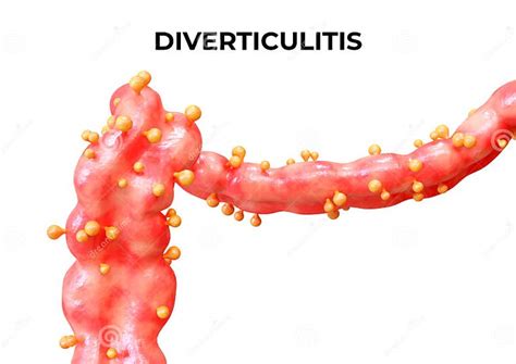 Echinacea And Diverticulitis