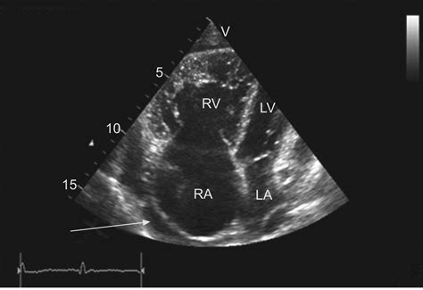 echocardiogram and pulmonary hypertension