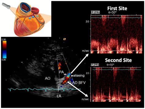 echocardiogram with doppler and color flow cpt code