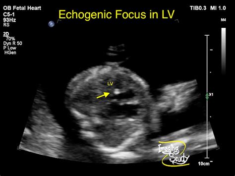 Understanding Echogenic Intracardiac Focus: Causes and Fetal Implications