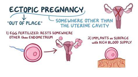 Understanding Ectopic Pregnancy Definition and Its Hidden Dangers