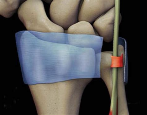 ecu tendon sheath tear