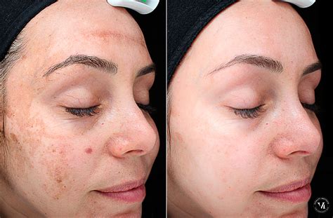 Women suffer third degree burns after DIY chemical peels Daily Mail