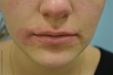 Eczema Around Mouth: Causes, Symptoms, and Effective Treatments