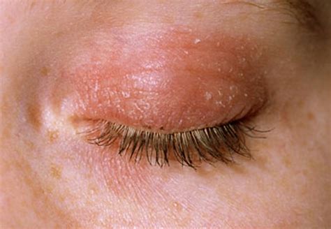 eczema baby eyelids