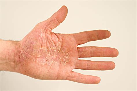 Soothe Dry, Itchy Hands: Effective Relief and Treatment for Eczema on Hands