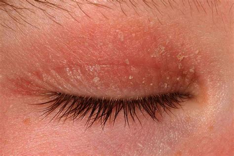 eczema on child's eyelids