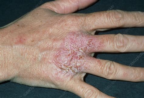Eczema on Knuckles: Causes, Symptoms, and Effective Treatments