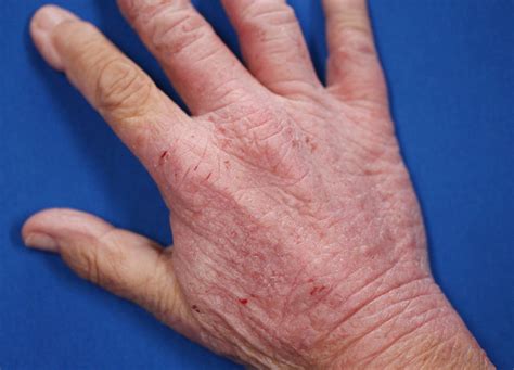 eczema pictures on hands