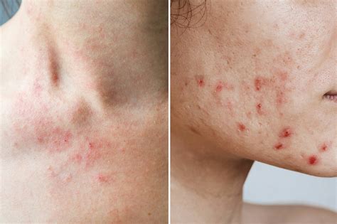 Eczema Pimples