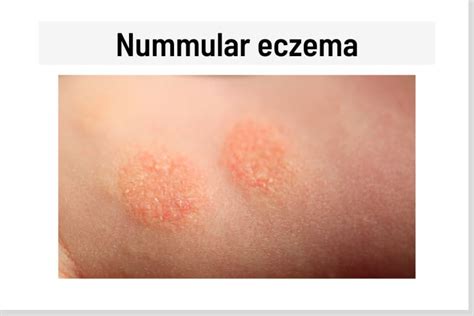 eczema rash circle