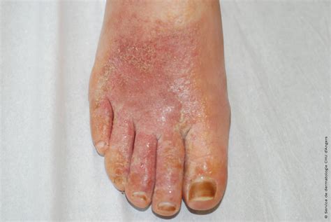 Eczema To Feet