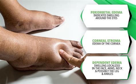 Edema Feet Cure