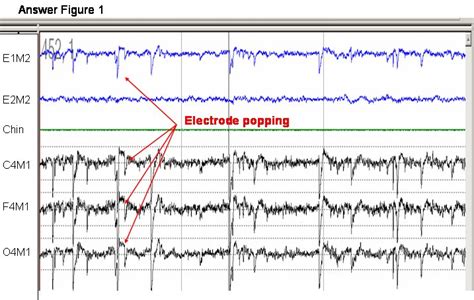 Eeg Electrode Pop Artifact