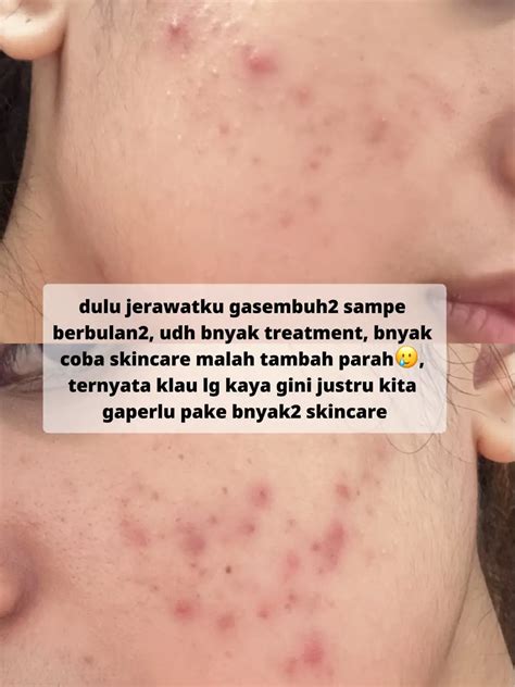 Jerawat Batu: Dampak dan Penanganan yang Tepat