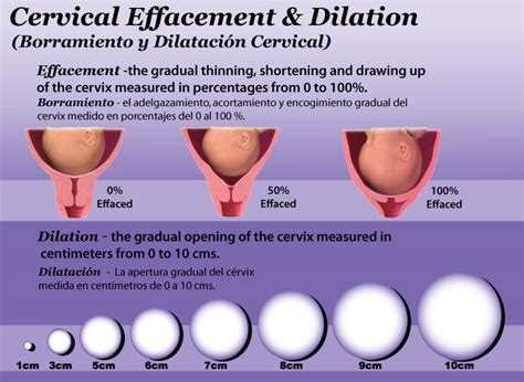 effaced and dilated chart