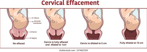 effacement definition