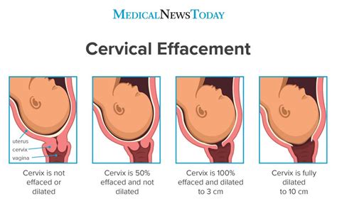 effacement of cervix