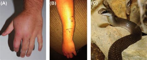 effects of boomslang bite