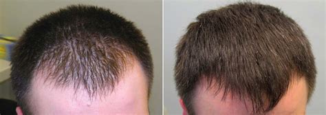 effects of finasteride on hair growth