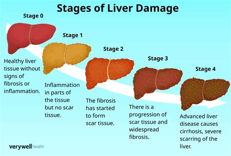 Stages of liver damage due to alcoholism. First alcohol compromises