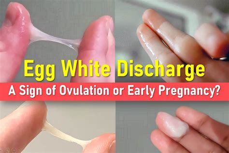 Egg White Discharge From Bum