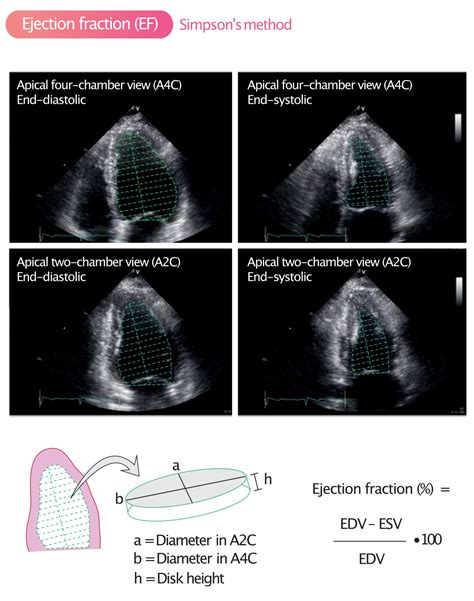 Ejection Fraction Echo Calculation