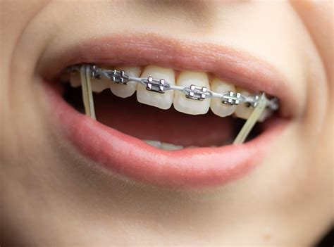 Elastics Braces Shop